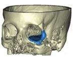 Final design of orbital floor implant